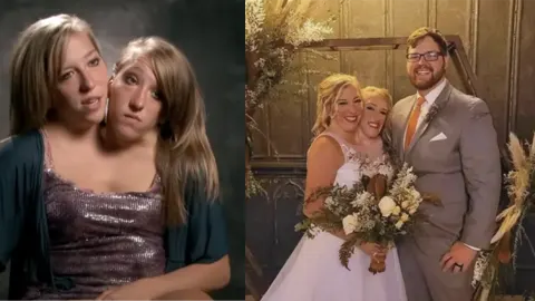 双头连体姐妹艾比成婚